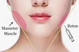https://neume-media-prod.s3.amazonaws.com/date=2025-07-13/1752399061789-Masseter_Botox_Slim_Your_Jawline_Without_Surgery_2.jpg