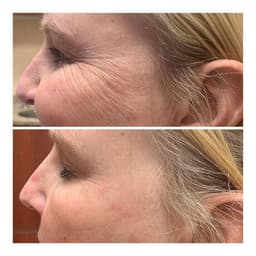 https://neume-media-prod.s3.amazonaws.com/date=2025-07-13/1752399264989-botox_treatment_wrinkles_mt_calvary_dental_fond_du_lac_county_030321.jpg