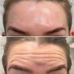https://neume-media-prod.s3.amazonaws.com/date=2025-07-13/1752399265183-Wrinkle_Reduction_Success_Ascot_Windsor_Bracknell.jpg