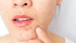 https://neume-media-prod.s3.amazonaws.com/date=2025-07-29/1753756455910-surprising_causes_of_adult_acne_00_alt_722x406.webp