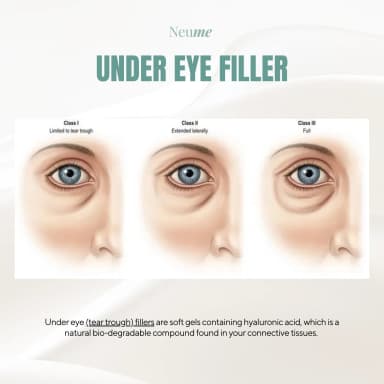 Aegyo (Under Eye) Filler