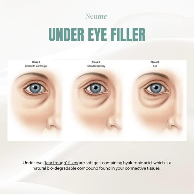 Aegyo (Under Eye) Filler