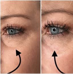 https://neume-media-prod.s3.amazonaws.com/date=2025-07-29/1753756631870-Undereye_filler_1_1013x1024.webp