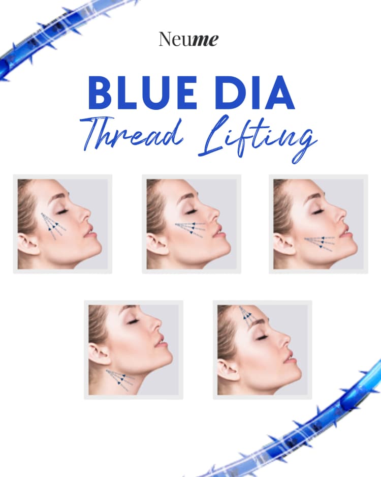 Blue Dia Thread Lifting