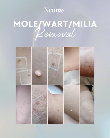 Moles, Skin Tags, Warts, and Milia Removal