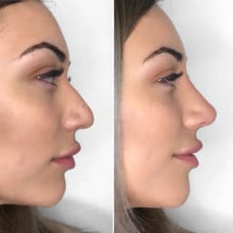 https://neume-media-prod.s3.amazonaws.com/date=2025-07-29/1753776123595-Nose_Tip_Plasty_Filler_Female_2.webp